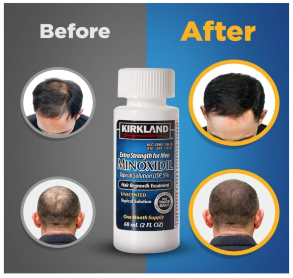 Home kirkland signature minoxidil 5% extra strength hair regrowth treatment for men, topical solution, 1 month supply, 2 fl oz bottle