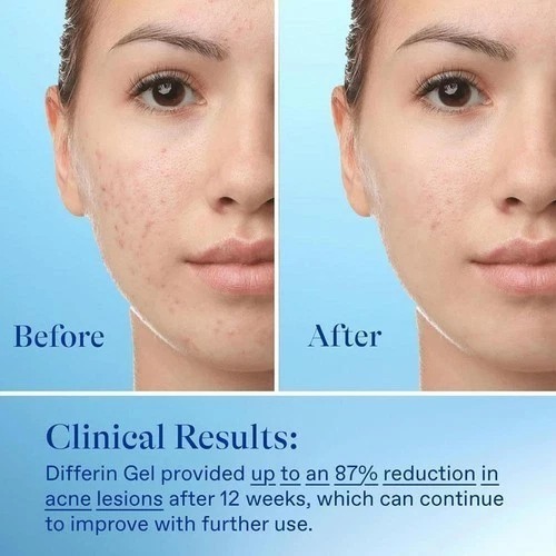 gel 45g retinoid treatment for face with 0.1% adapalen uk hot!